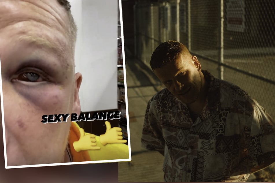 Schlägerei und Polizeieinsatz: 187 Strassenbande-Rapper Bonez MC schockt mit blutunterlaufenem Auge