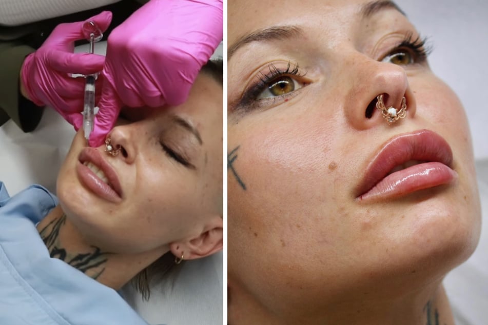 Edith Stehfest (30) zeigt auf Instagram ein Video ihrer Lippenunterspritzung.