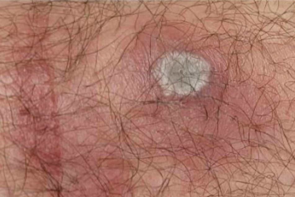 An Alaskapox lesion shown around the time symptoms were first reported, according to the Alaska Division of Public Health.