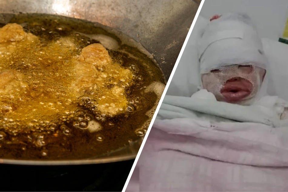 Restaurant-Besuch endet in Albtraum: Kind (3) mit heißem Öl übergossen, halber Körper ist verbrannt