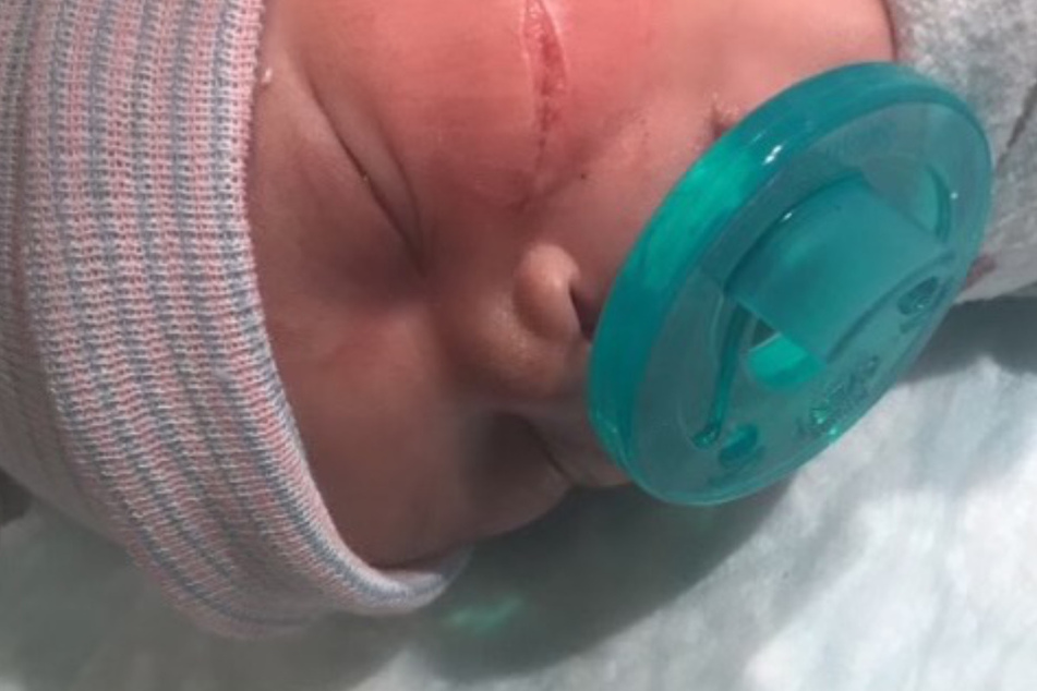 Ärzte verletzen Gesicht von Baby bei Not-Kaiserschnitt