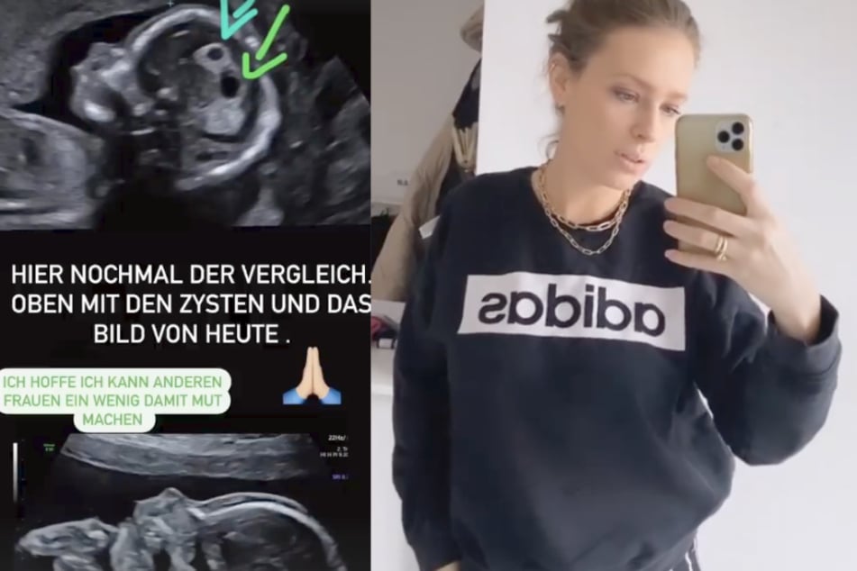 Yvonne Schröder (33) berichtete in ihrer Instagram-Story von ihrem Frauenarzttermin.