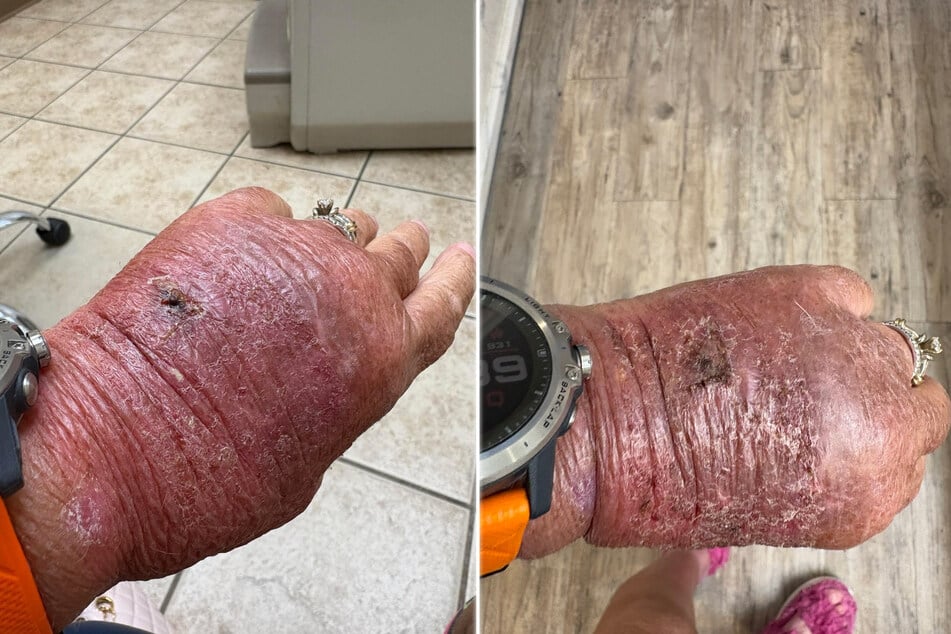 Drei Tage liegen zwischen den Bildern, die Schwellung ist deutlich zurückgegangen (r.).