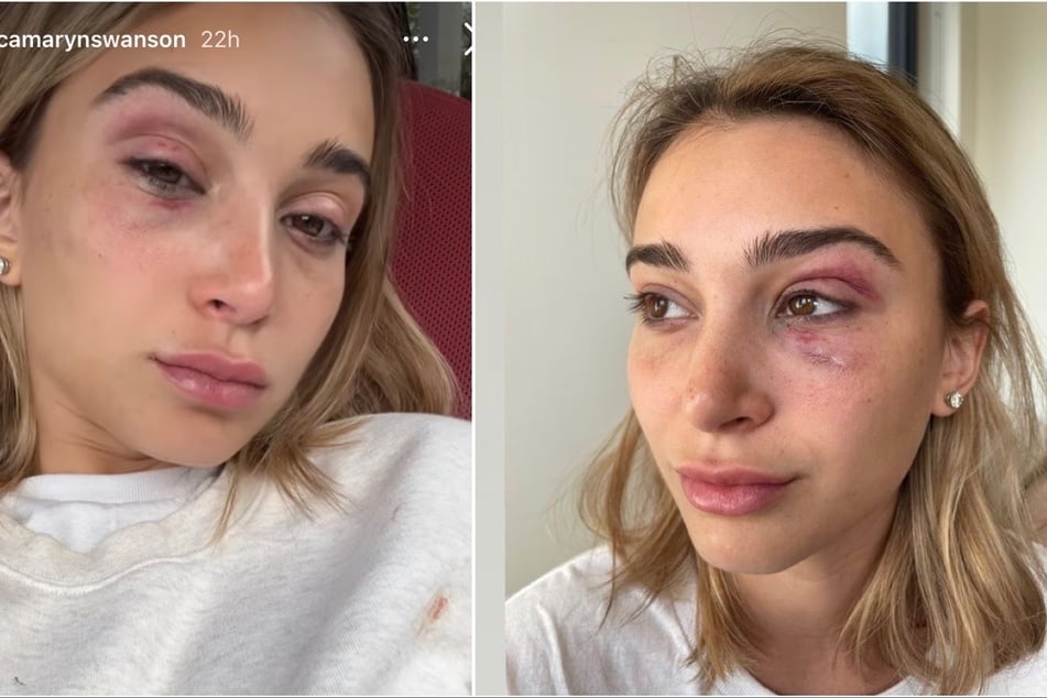 Model Camaryn Swanson shared a series of photos showing the injuries she claimed she received from Tyga.