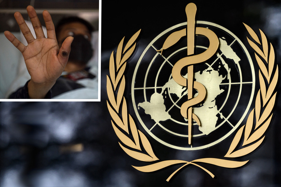 Monkeypox is no longer considered an international health emergency, the World Health Organization (WHO) declared on Thursday.