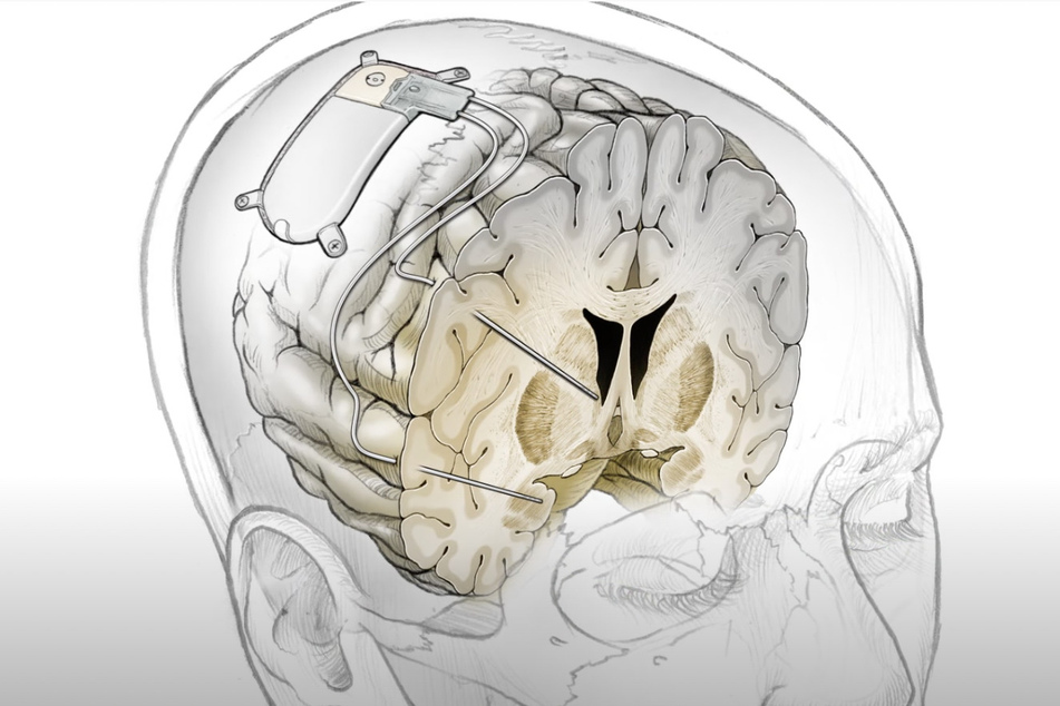 A model of the new "brain pacemaker" implant and a cross-section view of the old noodle - the brain.