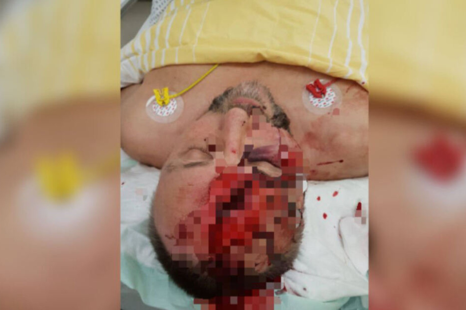 Auch nach der Attacke auf den AfD-Politiker Frank Magnitz (die AfD postete dieses Foto anschließend auf Facebook), kam der Hashtag #Nazisraus zum Einsatz.