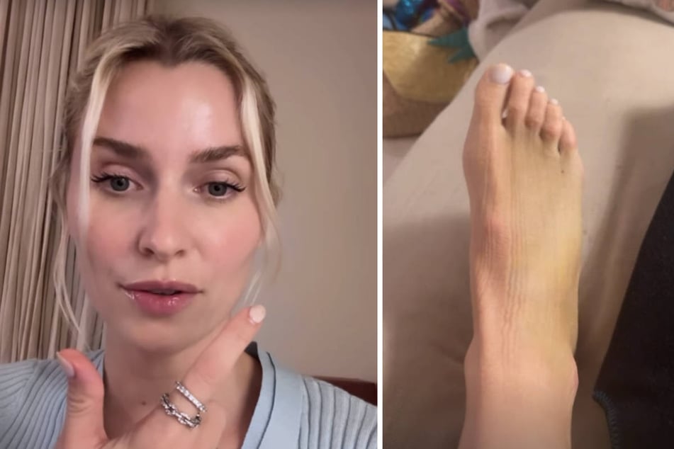 Lena Gercke zeigt ihren lädierten Fuß.