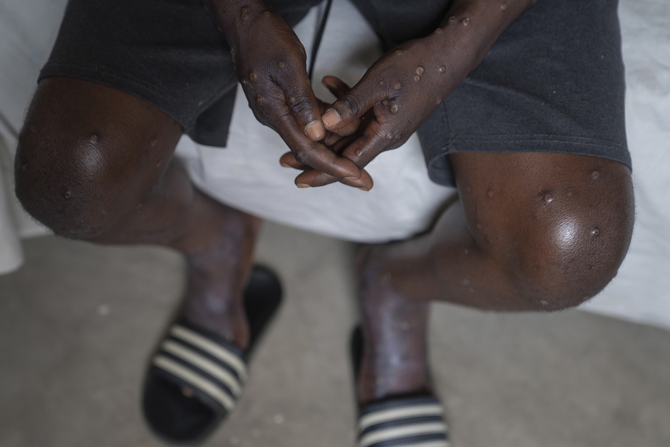 Ein mit Mpox infizierter Mann sitzt im Allgemeinen Krankenhaus von Goma, wo er weiter behandelt wird.