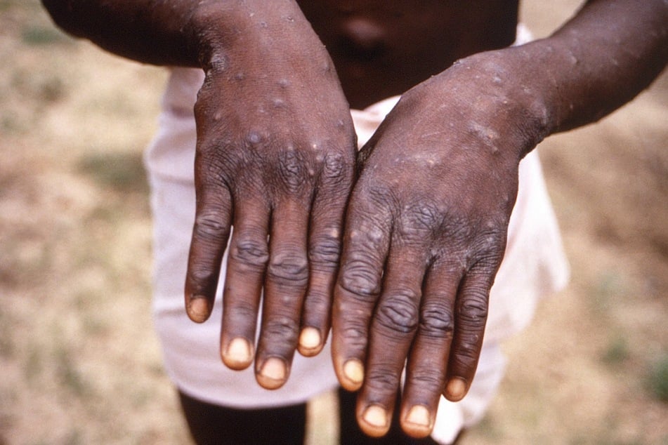 A photo of monkeypox symptoms taken during an outbreak in the Democratic Republic of the Congo in the late 90s.