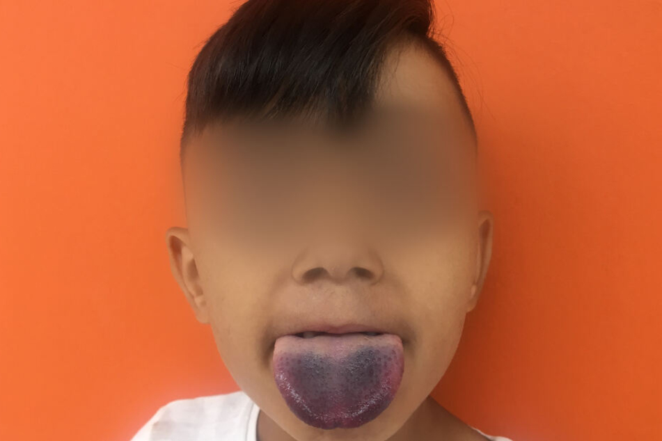 Das Kind zeigt seine violett verfärbte Zunge, die stark angeschwollen war.