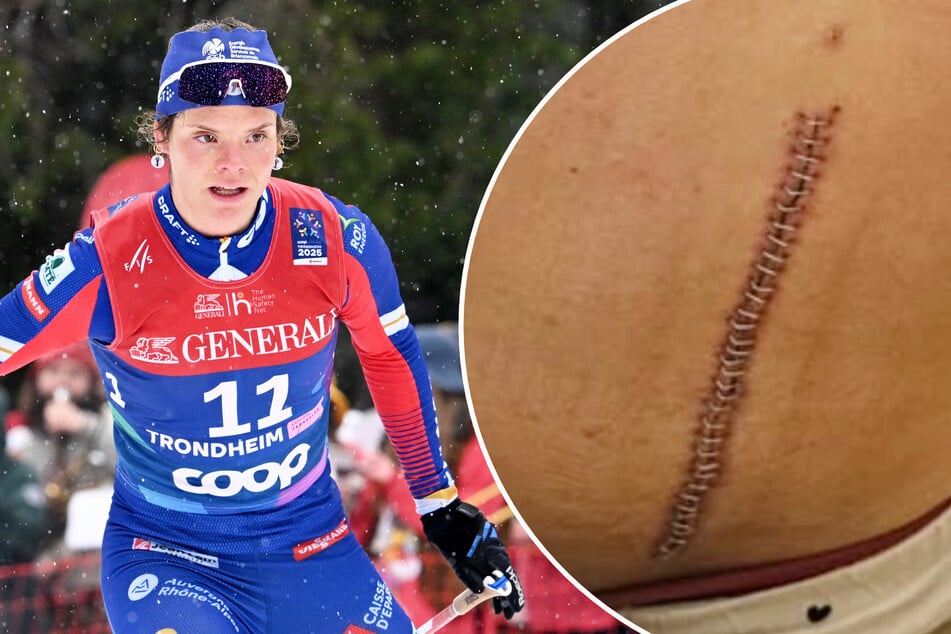 Absturz mit dem Gleitschirm: Olympia-Hoffnung zeigt Horror-Narbe