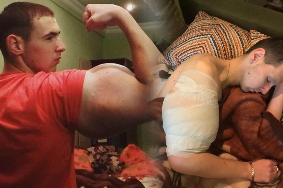 Kiril Tereshin (21) hat es mit seinen Synthol-Injektionen entgültig übertrieben.