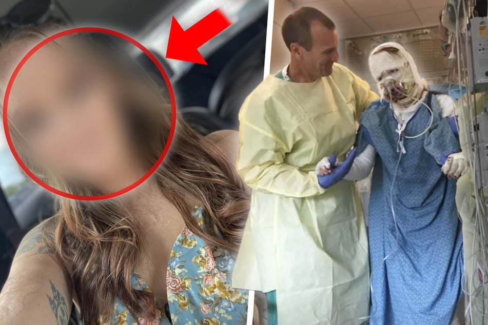 Schreckliche Explosion zerstörte ihr Gesicht: So sieht die junge Frau sechs Jahre später aus