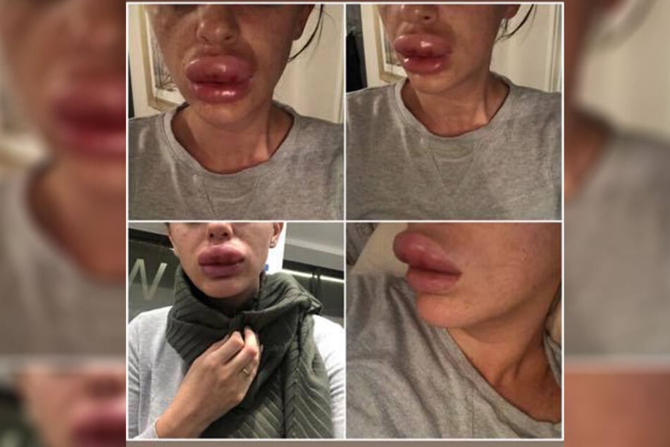 Auf Facebook lud sie mehrere Bilder ihrer entstellten Lippen hoch.