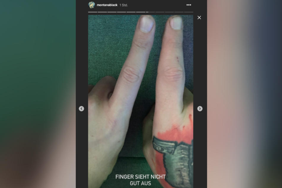 Der rechte Finger des YouTubers ist deutlich angeschwollen.