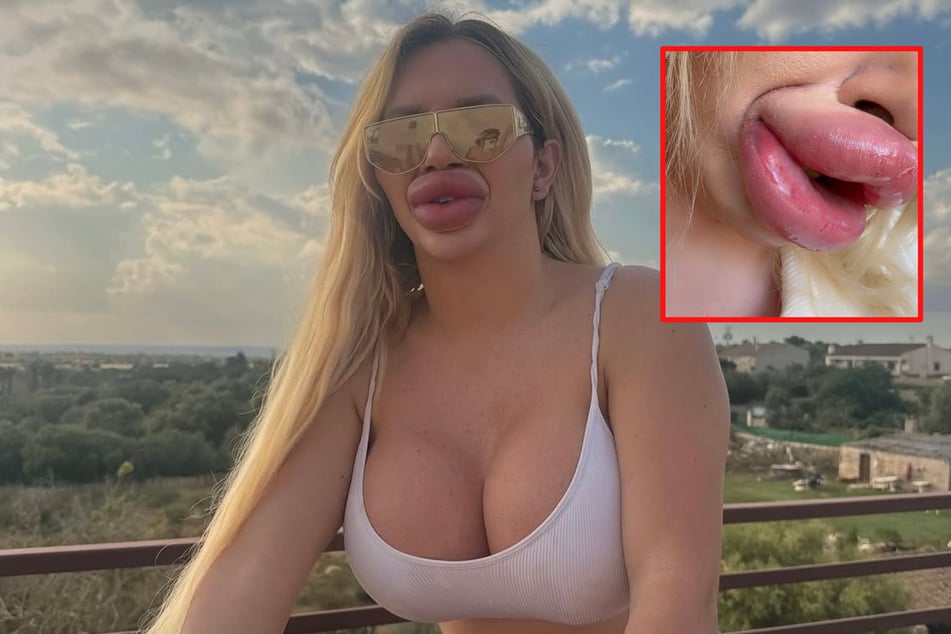 Jede Woche Lippen aufspritzen? So viel kostet Viennas Schmollmund-Rekord
