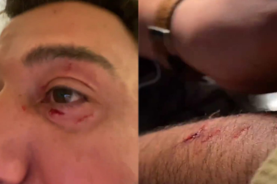 Kubilay Özdemir (41) zeigt in seiner Insta-Story seine Verletzungen.