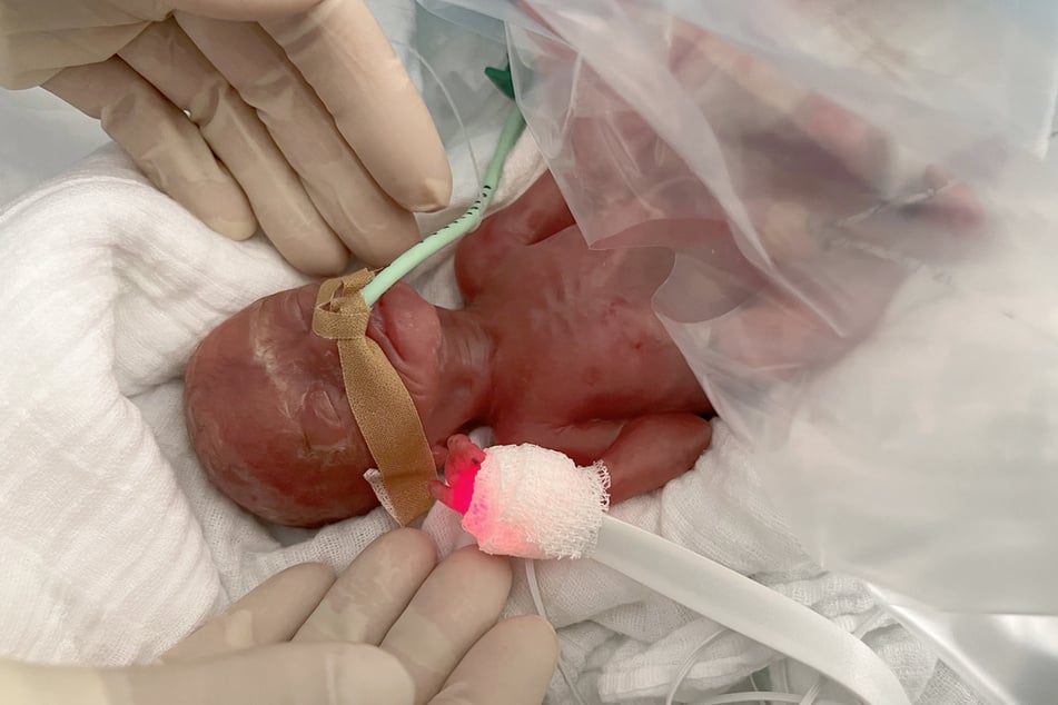 In der Magdeburger Uniklinik ist ein Baby 16 Wochen zu früh auf die Welt gekommen.