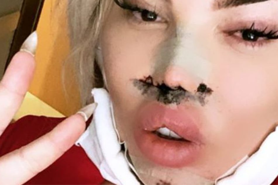 In ihrer Instagram-Story präsentierte sich Jessica Alves (37) nach dem verpfuschten Eingriff mit mehreren Pflastern und Hämatomen.