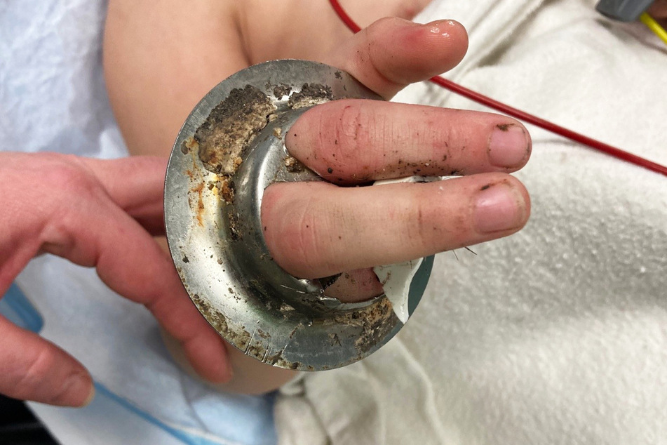 Die Fünfjährige musste in Vollnarkose versetzt werden, bevor es gelang, ihre Finger aus dem Abflussgitter zu befreien.