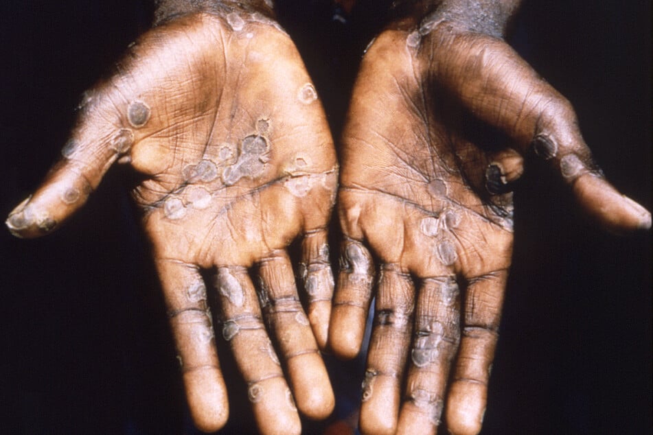 Dieses Bild aus dem Jahr 1997 entstand während einer Untersuchung eines Affenpockenausbruchs in der Demokratischen Republik Kongo.