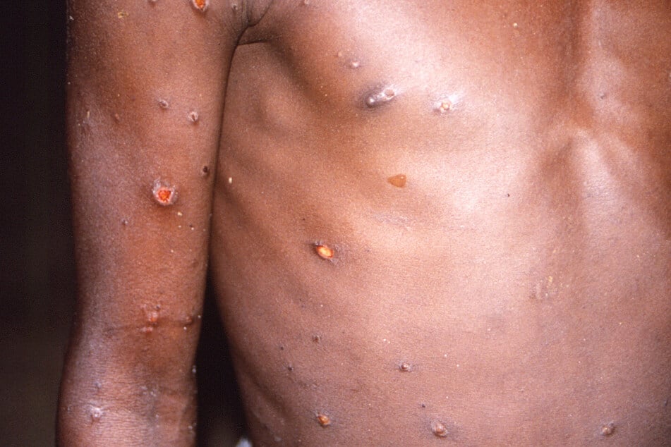 Ein Bild aus dem Jahr 1997 zeigt, wie ein mit dem Affenpockenvirus infizierter Körper aussehen kann.