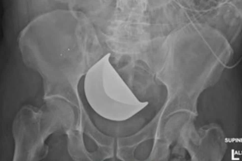 Dieses Röntgenbild zeigt die Klinge, die im Körper des Patienten vergessen wurde.