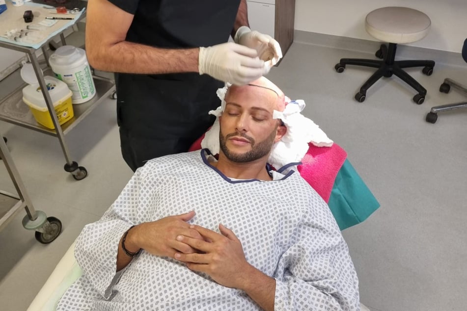 Domenico während seiner Haartransplantation, die insgesamt neun Stunden dauerte.