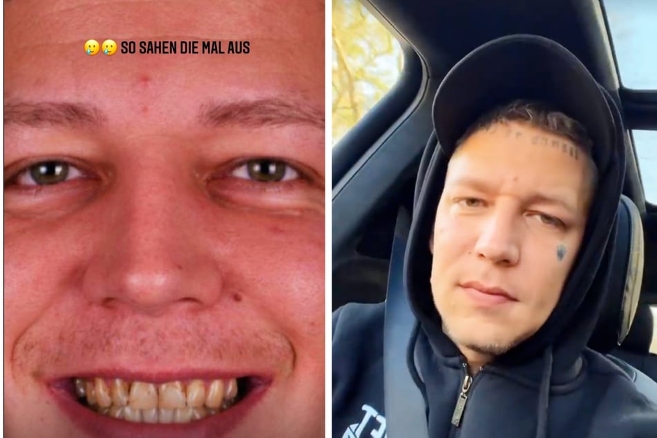 YouTuber MontanaBlack (34) lässt sich aktuell ein neues Gebiss machen. Am Freitag zeigte er erstmals seine "alten" Zähne auf Instagram.