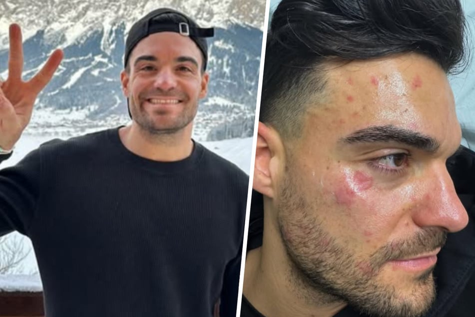 Koch-Influencer Stefano Zarrella (34) hat sich bei einem Küchen-Unfall heftig das Gesicht mit heißem Fett verbrannt.
