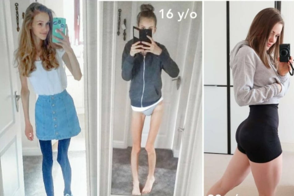 This anorexia survivor almost died before making a remarkable transformation