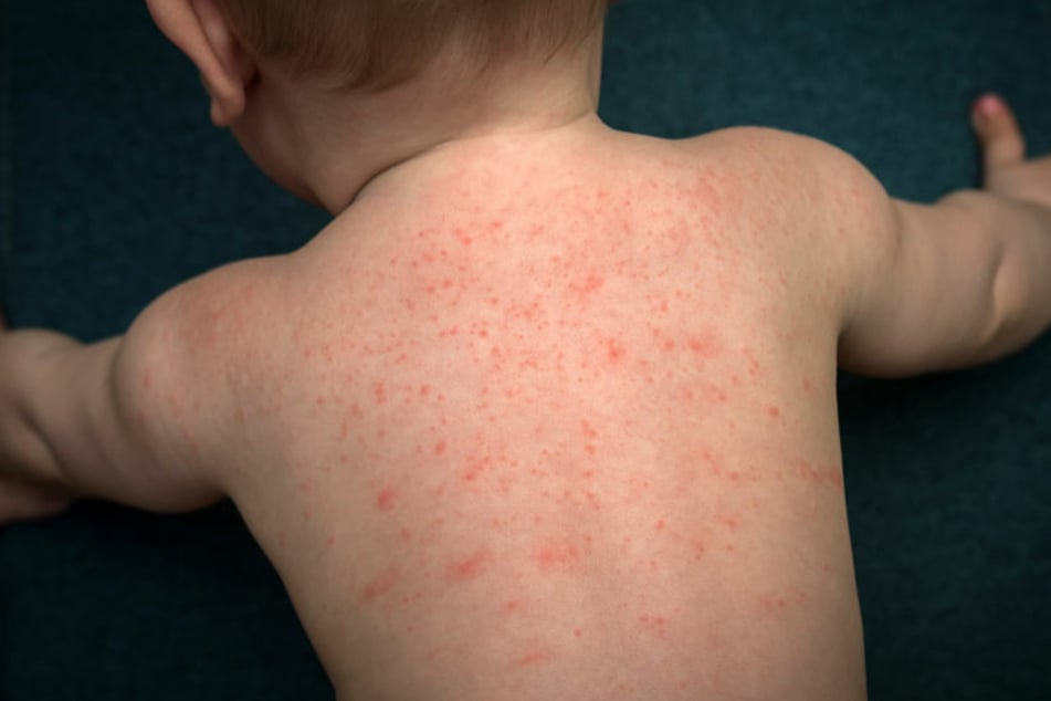 Bei Baby Arthur entwickelte sich nach der Geburt ein extremer Hautausschlag, der sogar noch schlimmer als der, der auf dem Bild dargestellt ist, aussah. (Symbolbild)