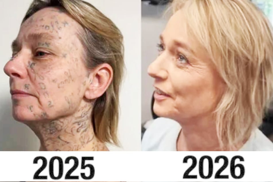 Dank der Hilfskampagne einer niederländischen Stiftung konnten bereits viele Tattoos bei Joke weggelasert werden.