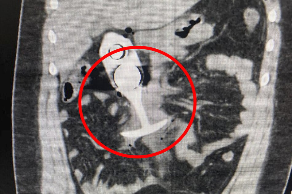 Das Sexspielzeug machte sich im MRT selbstständig und landete im Körper der 23 Jahre alten Patientin.