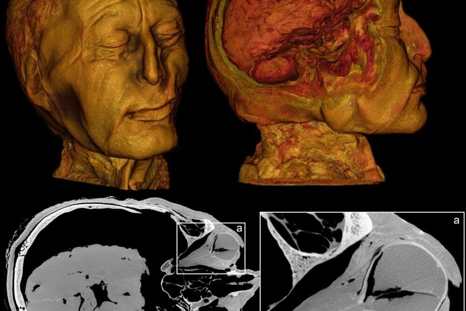 Die Forscher scannten das Gesicht des Mannes mit moderner Mikro-CT-Technik. Der letzte Scan von 2002 hatte eine deutlich schlechtere Auflösung.