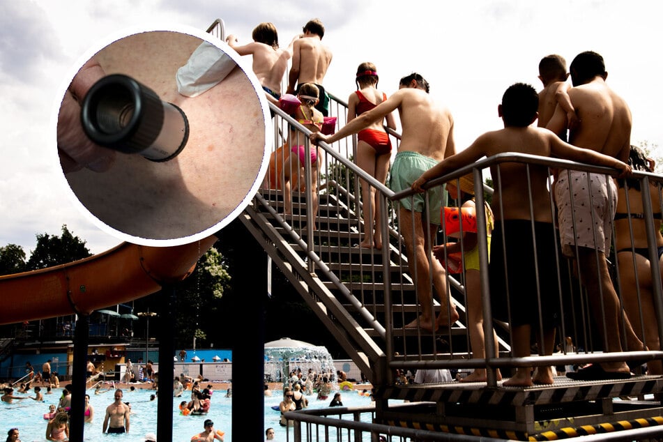 Berlin: Gefährliche UV-Strahlen: Gratis Hautcheck für Neuköllner Freibad-Besucher!