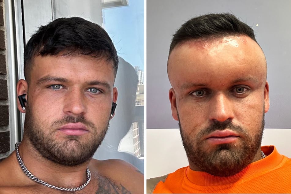 Bei Ryan Briggs (27) aus Blackpool hat sich nach dem Färben der Haare ein "Ballonkopf" gebildet.