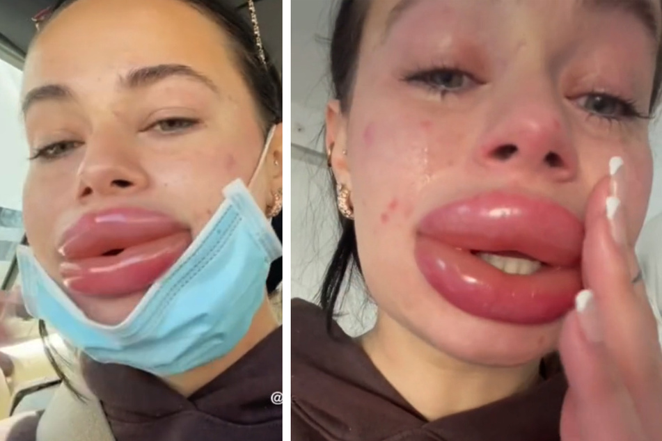 Jessica Cailey Burko (27) ließ sich die Lippen aufpolstern. Nach dem Eingriff kam es zu einer gigantischen Schwellung.