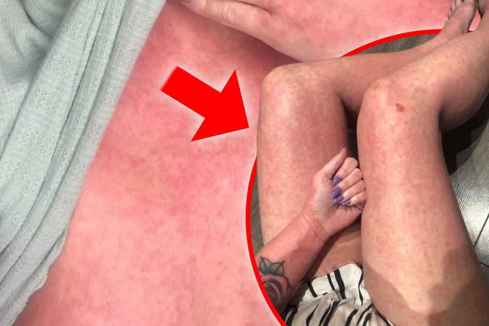 Hautleiden ohne Anerkennung: Betroffene fühlen sich alleingelassen