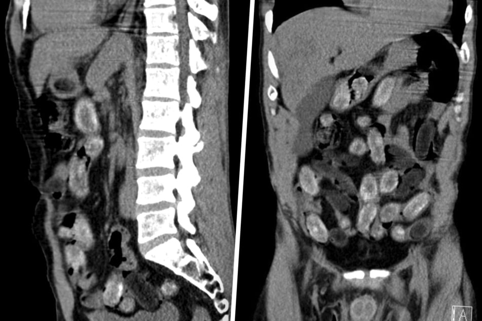 Die Röntgenaufnahmen zeigen zahlreiche Drogenpäckchen im Magen-Darm-Trakt des Mannes.
