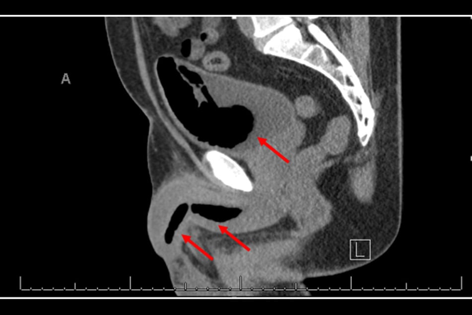 CT-Scan: Die Pfeile zeigen auf den Sprühschaum in den Harnwegen.