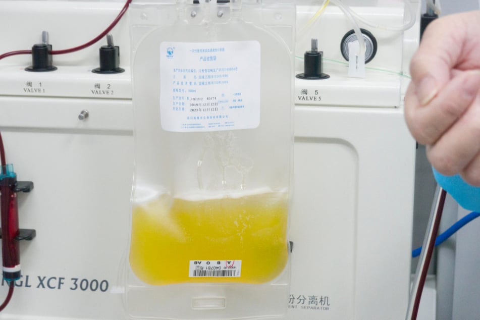 China, Wuhan: Gespendetes Plasma eines geheilten Coronavirus-Patienten wird in einem Plasmabeutel aufgefangen (Archivbild).