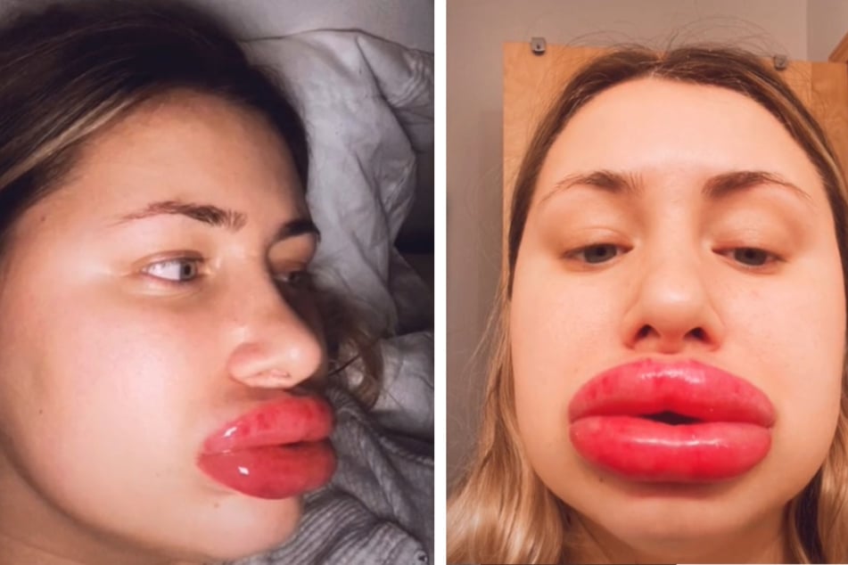 Den Mund zu voll genommen: Kailee Jones (23) präsentierte ihre geschwollenen Lippen auf TikTok.