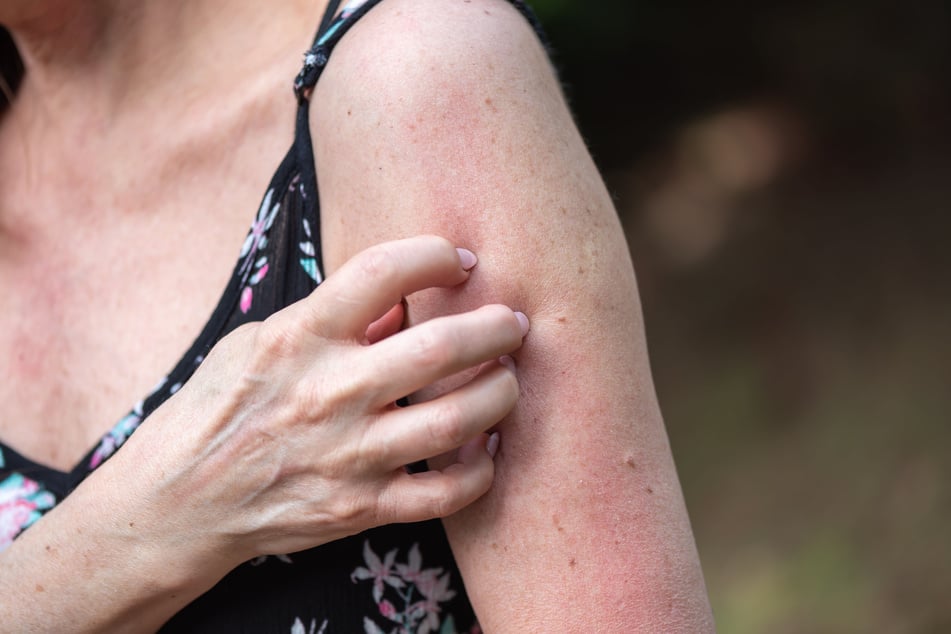 Über mehrere Wochen kämpfte die Familie mit extremem Juckreiz. (Symbolfoto)