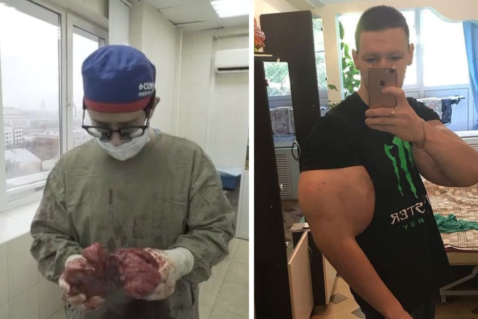 Real-life Popeye could lose limbs after pumping them full of petroleum jelly!