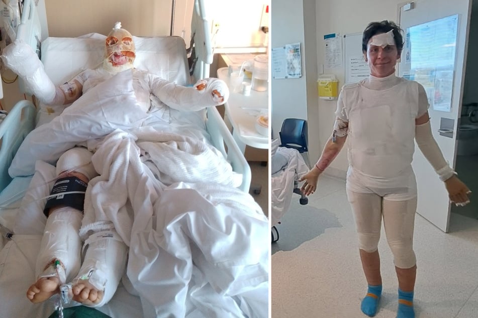 Katja Grosse (41) aus Australien überlebte eine Explosion in ihrer selbst gebauten Sauna. Mehr als 50 Prozent ihres Körpers wurden bei dem Unglück verbrannt.