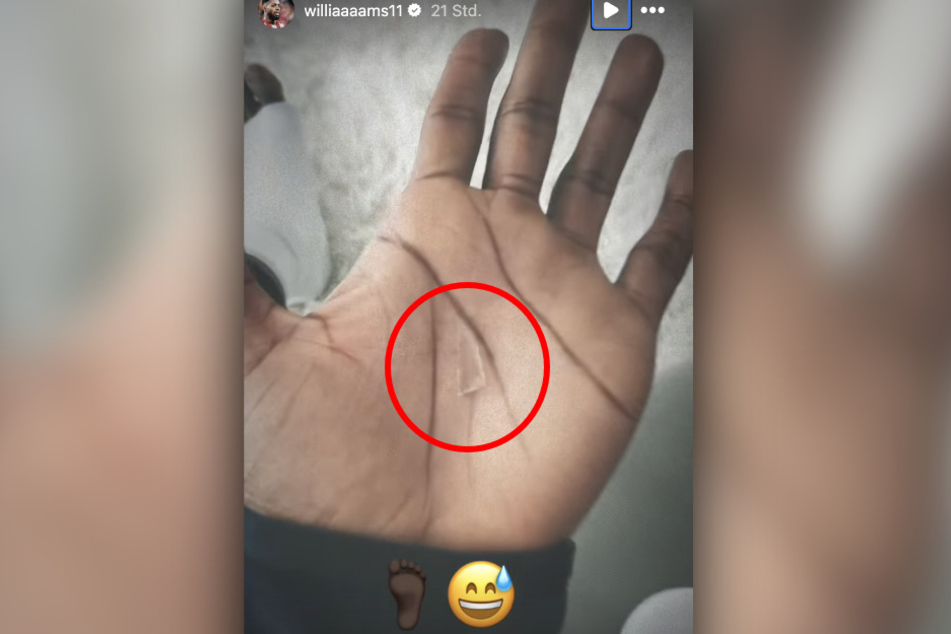 Auf Instagram hat Iñaki Williams den spitzen Störenfried in seinem Fuß präsentiert.