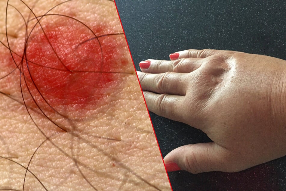 The sting of a wasp will look like most stings – red and raised. Some people can experience extreme swelling, though, and even anaphylactic shock.
