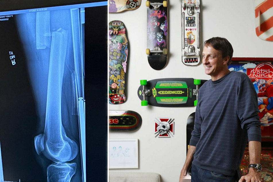 Skateboarding legend Tony Hawk in recovery after brutal leg break